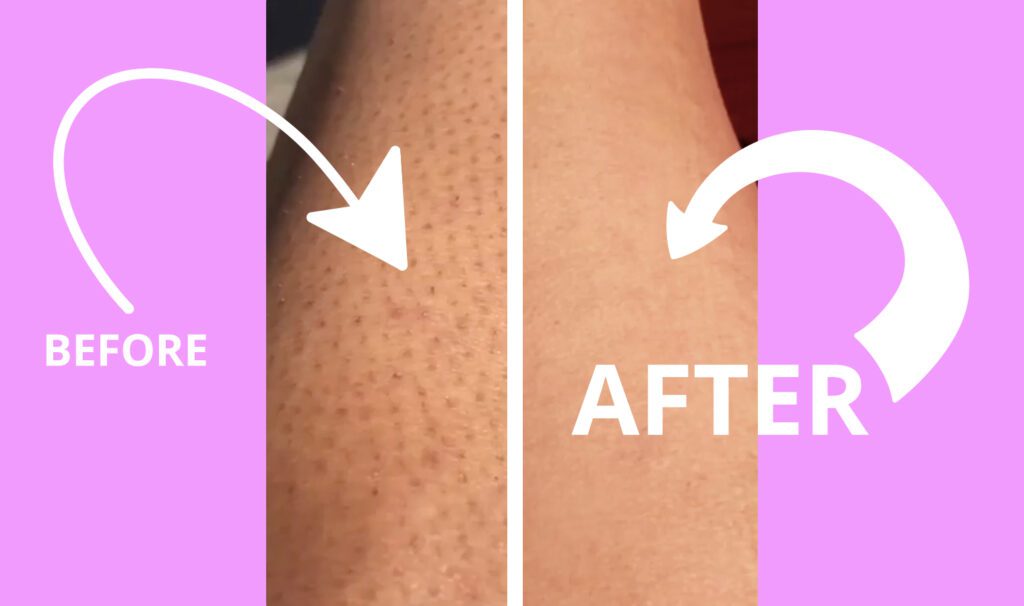 Bleame Hair Eraser Review: Does It Really Work? 6 Before and after Results after using Bleame Hair Eraser Tool